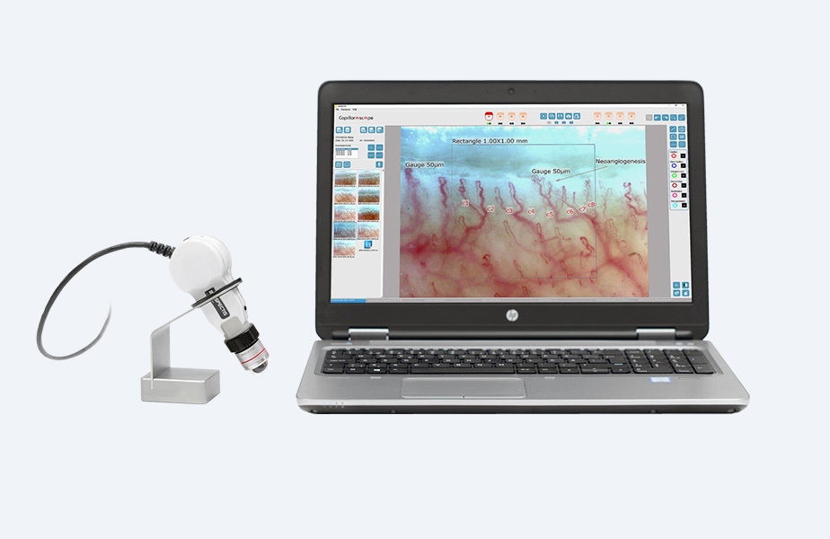 Digital Video Capillaroscopy